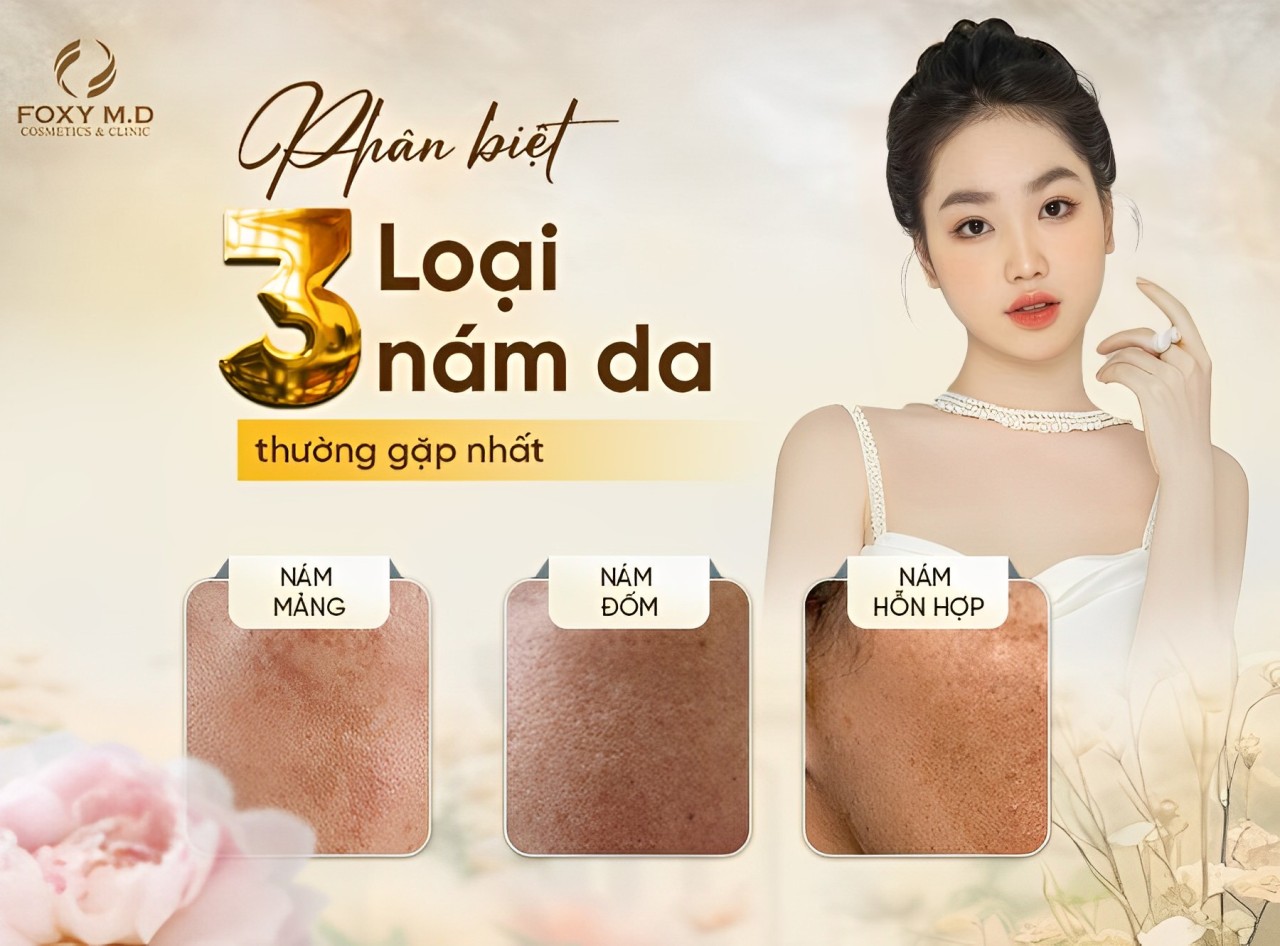 Điều Trị Nám Da Mặt Tại Thẩm Mỹ Viện Foxy M.D – Giải Pháp Chuyên Sâu, Hiệu Quả Cao